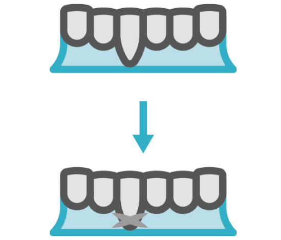 Casos en los que es conveniente una cirugía Mucogingival