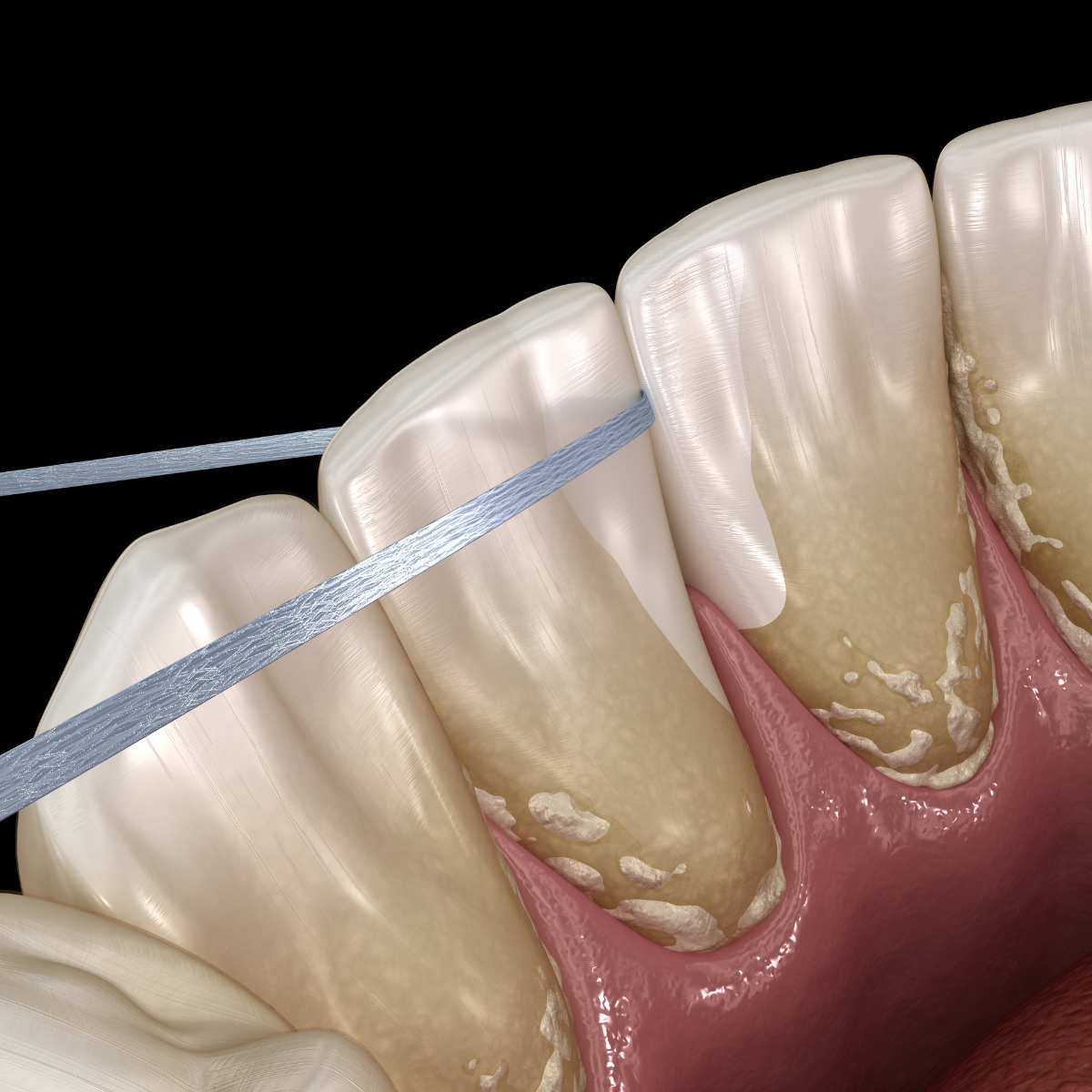 ¿Qué es la placa dental o placa bacteriana?