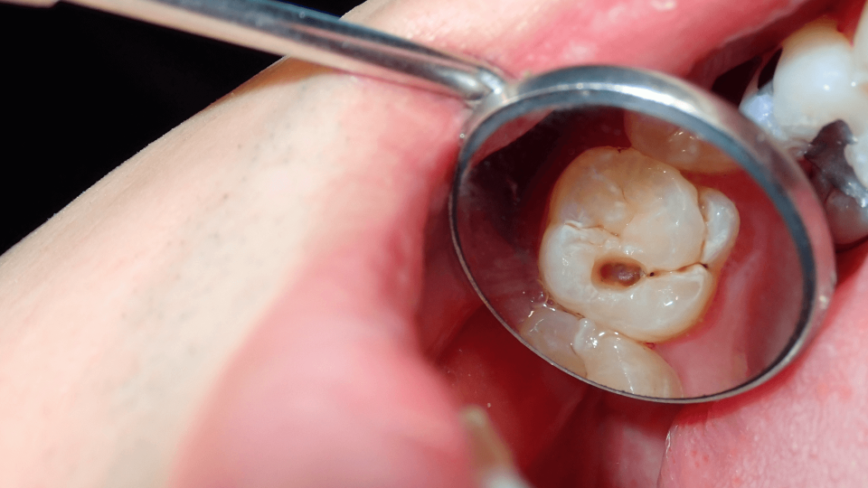 La caries