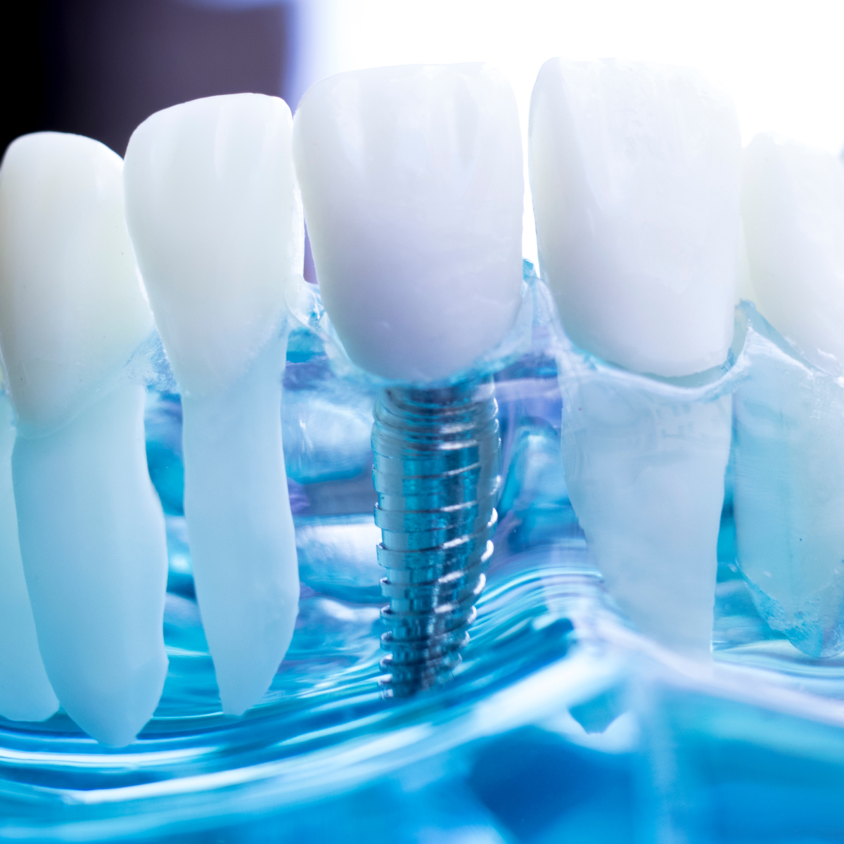 Periimplantitis