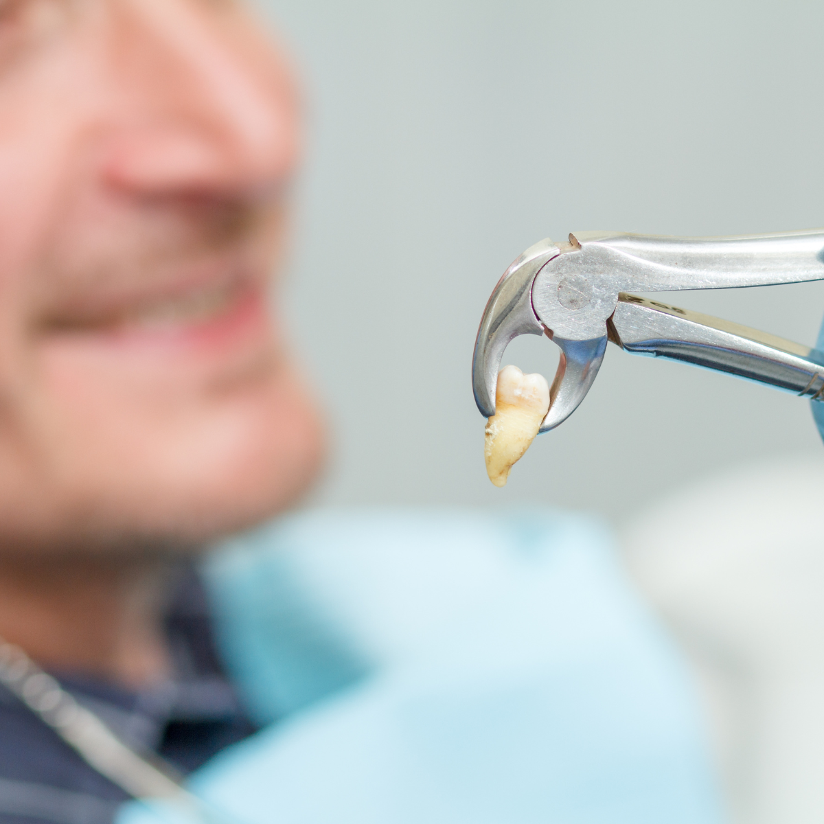 ¿Qué es una extracción dental, en qué consiste?