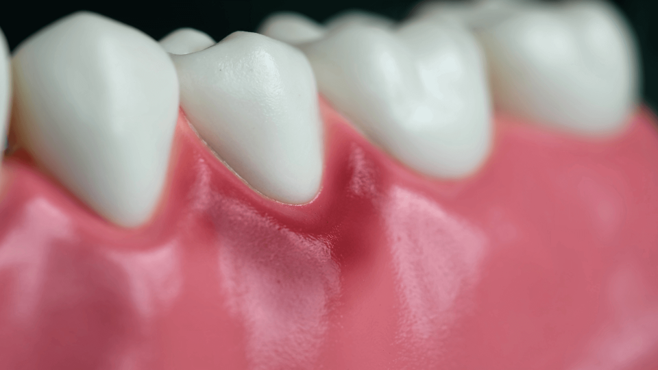 El Dr. Mariano Hernández en Onda Cero: tipos de gingivitis que existen.