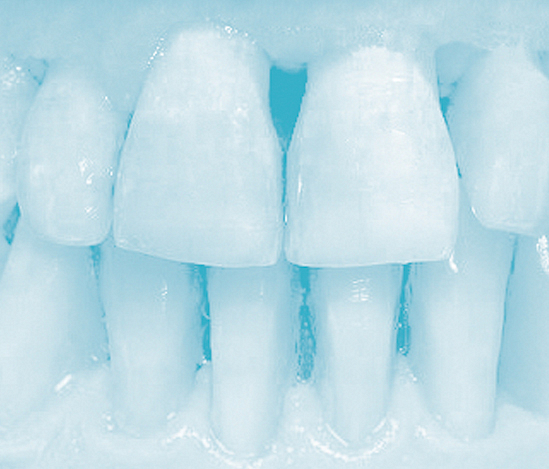 Carillas Dental Carillas Dental