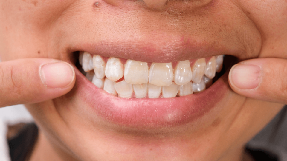 El Dr. Mariano Hernández en Onda Cero: las manchas blancas en los dientes.