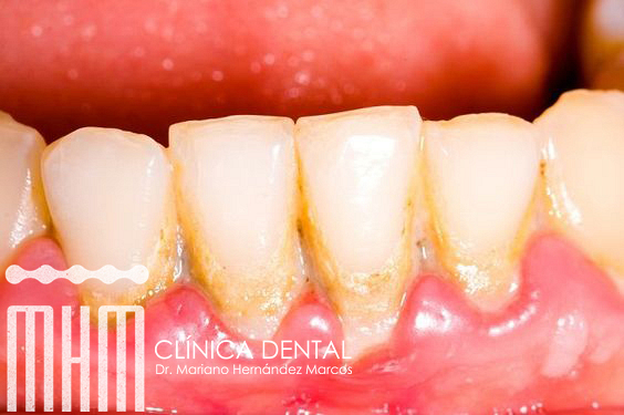 ¿Qué es la placa dental?