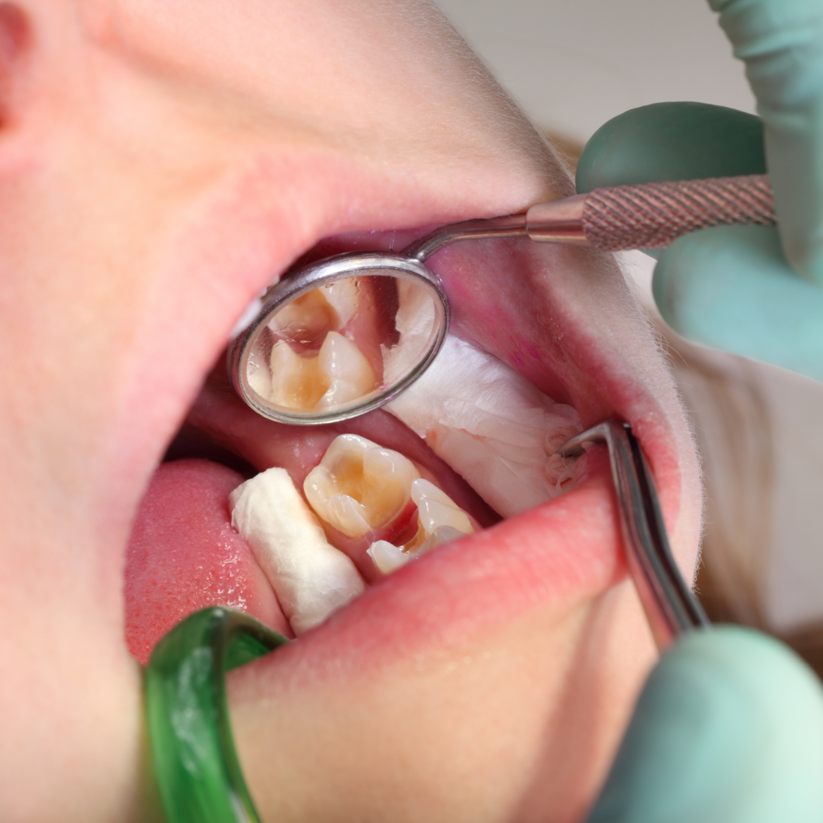 Uno de los principales problemas de salud bucodental en todo el mundo.
