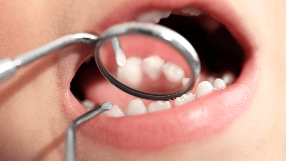 El Dr. Mariano Hernández en Onda Cero: La Recidiva de la Caries.