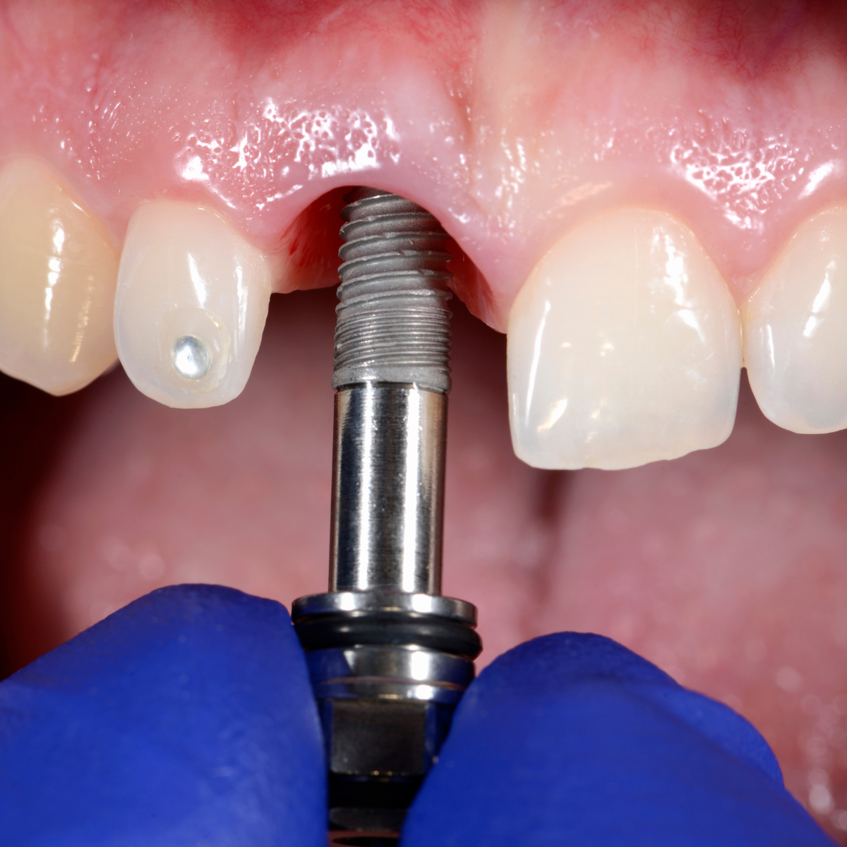1.- ¿Que son los implantes dentales ?