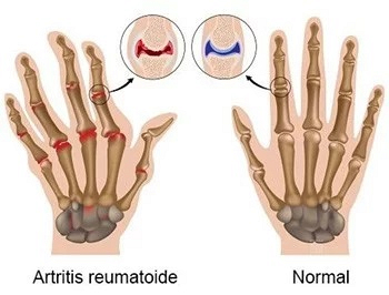 ¿Qué es la artritis reumatoide?