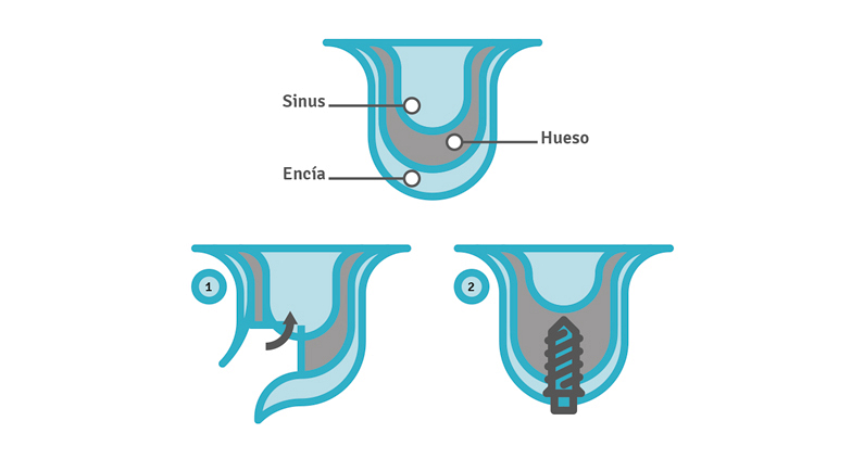 Aumento del suelo sinusal hecho simple Aumento del suelo sinusal hecho simple