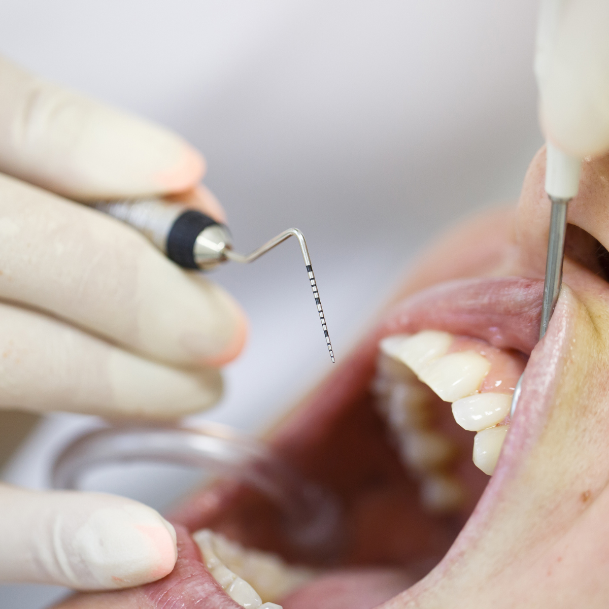 ¿Cómo se trata una periodontitis? ¿Cómo se trata una periodontitis?