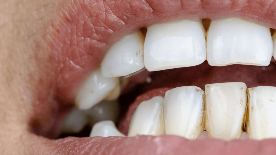 El Dr. Mariano Hernández en esta entrevista de Onda Cero habla sobre las manchas en los dientes.