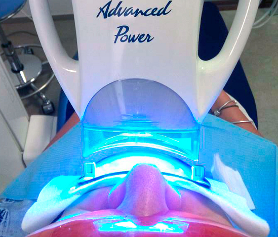 Blanqueamiento Dental Led (En Clínica) Blanqueamiento Dental Led (En Clínica)