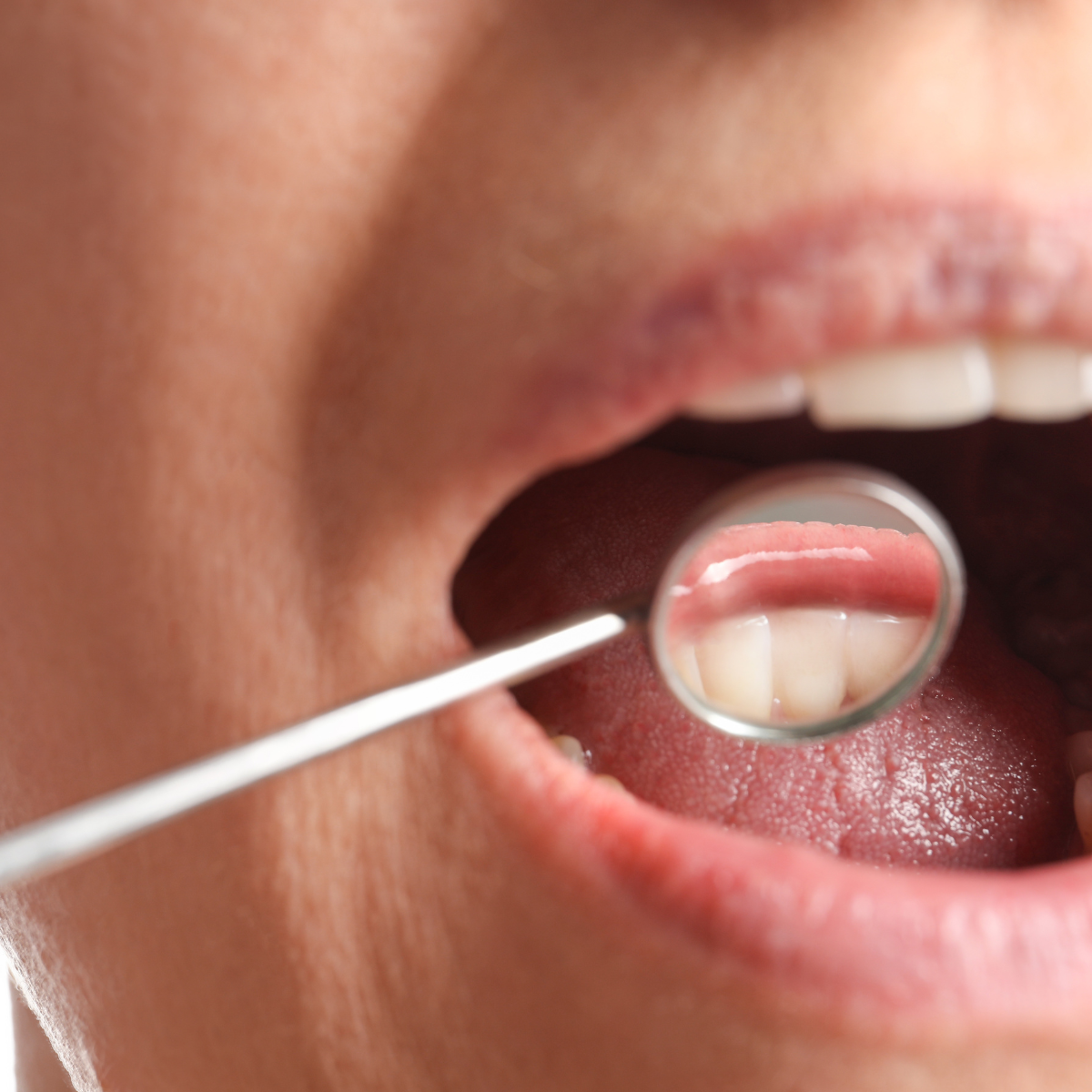 ¿Qué es el cáncer oral? ¿Qué es el cáncer oral?