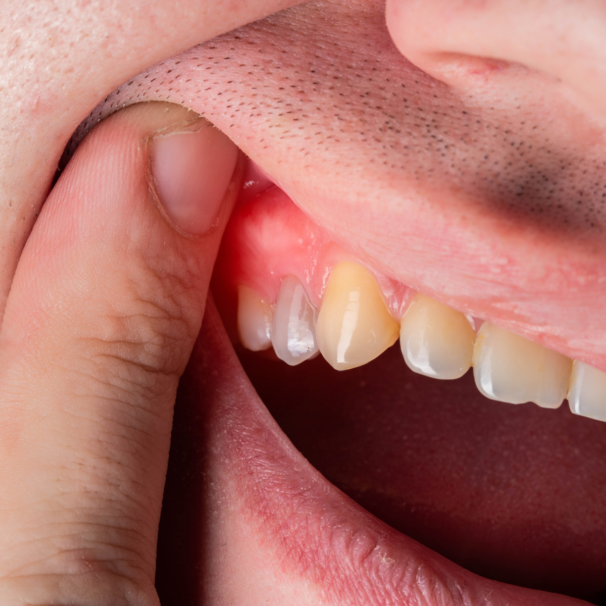 EFECTOS DEL TRATAMIENTO LOCALES DE LAS ENFERMEDADES PERIODONTALES EFECTOS DEL TRATAMIENTO LOCALES DE LAS ENFERMEDADES PERIODONTALES