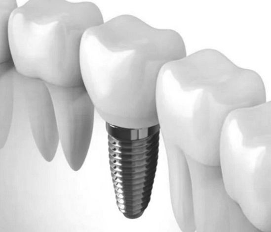 ¿Cómo Son los Implantes Dentales? ¿Cómo Son los Implantes Dentales?