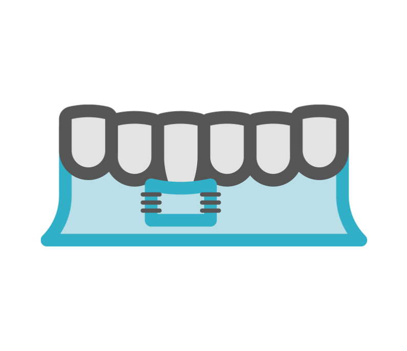 Cirugía Mucogingival para tratar la retracción periodontal