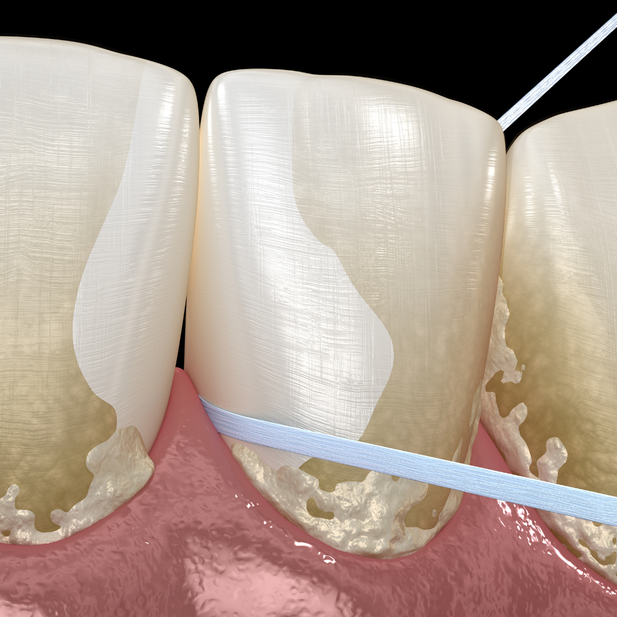 ¿Cuál es la cronología de la placa dental? ¿Cómo se va formando en el tiempo?