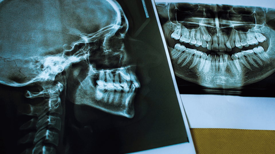 El Dr. Mariano Hernández en Onda Cero: radiografías dentales.