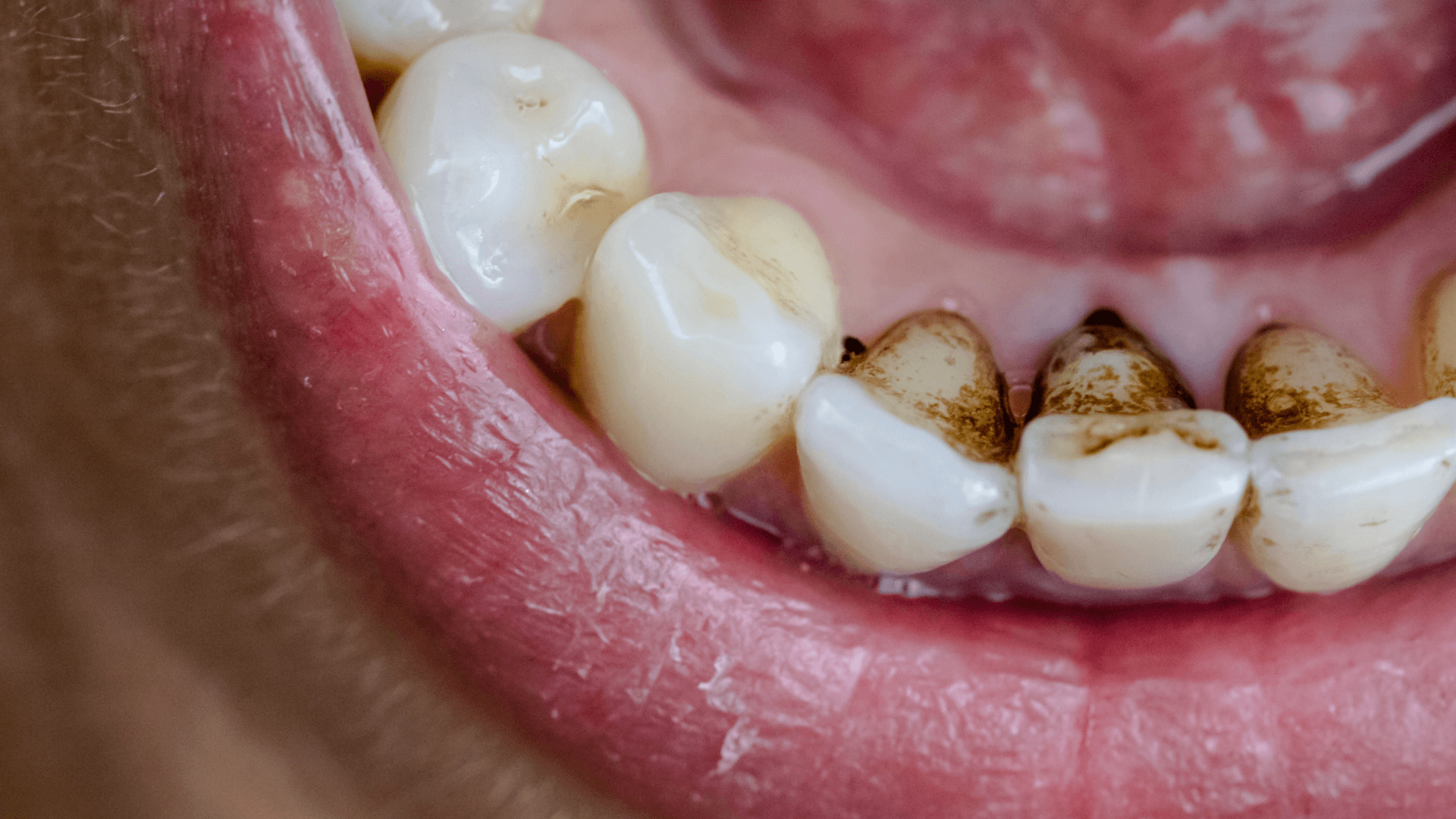Manchas negras en los dientes Manchas negras en los dientes