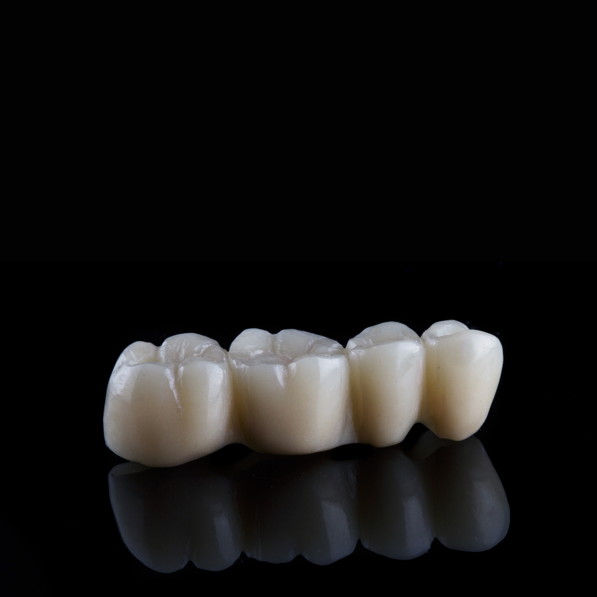Incrustaciones dentales Incrustaciones dentales