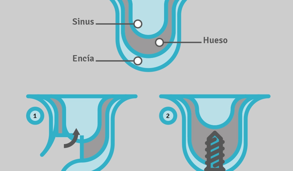 Implantes Sin Elevación de Seno